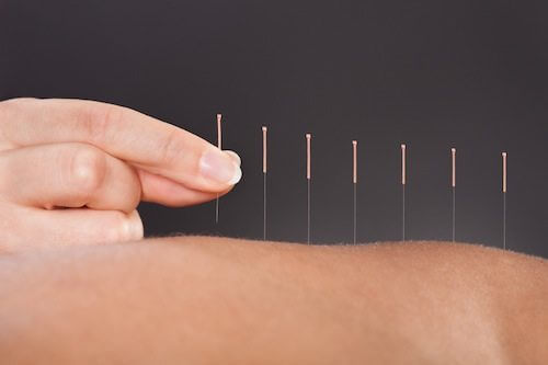 pd-acupuncture-inarticle